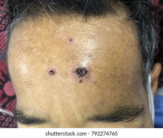 Multiple Black Crusts At Forehead In Middle Age Man Who Presented With Severe Sepsis And Septic Shock.