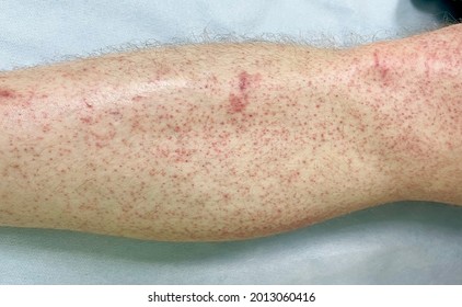 Multiple Erythematous Itchy Rash Papule Left Stock Photo 2013060416 ...