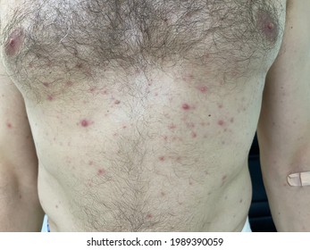 Multiple Erythematous Papule At Chest Wall And Abdominal Wall In A Man Who Has Allergic Reaction. 