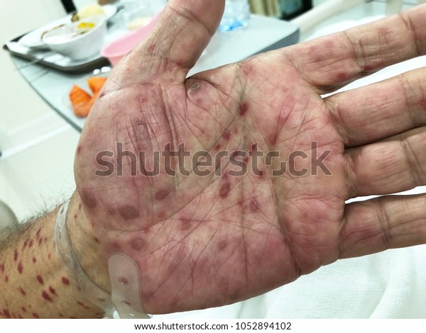 Multiple erythematous patch with white\
scale at palms, this picture focus at left hand in case secondary\
syphilis with HIV\
co-infection.