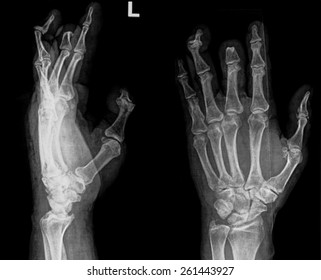 Multiple Fracture Finger Stock Photo 261443927 | Shutterstock