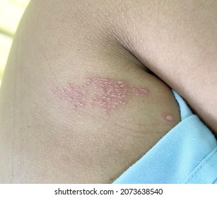 Multiple groups of clear vesicles at right side of the body in a lady who has Herpes Zoster infection. 