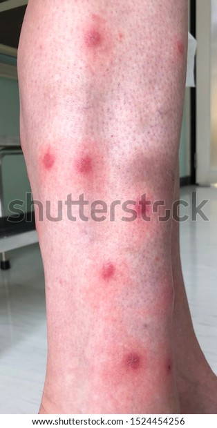 Multiple Illdefine Erythematous Itchy Papule Vesicles Stock Photo (Edit ...