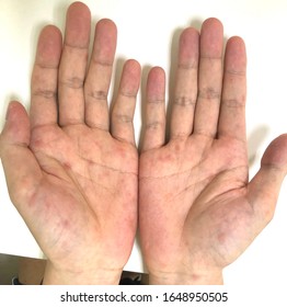 Multiple Ill-defined Erythematous Round And Oval Rash At Both Hands In A Gentle Man Who Has Secondary Syphilis.