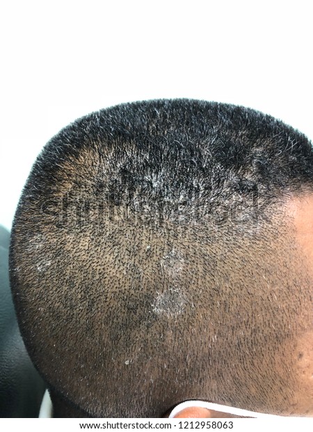 white scalp patches)