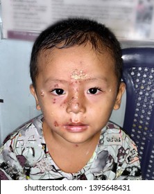 impetigo in children face