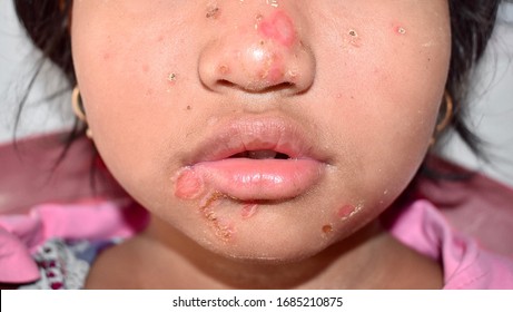 impetigo in children face