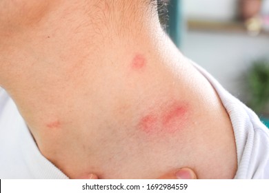 Multiple itchy mosquito or insect bite wheals; allergies in neck and nape area of Southeast Asian, Chinese adult young man with closeup view.