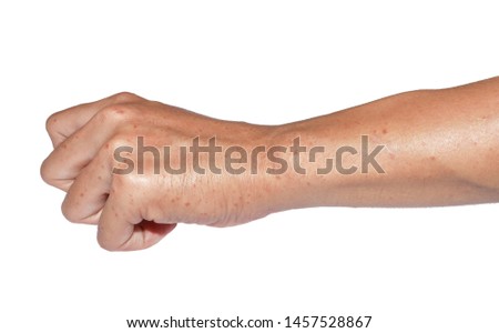 Multiple itchy Mosquito or insect bite wheals; allergies at fair skin in hand and forearm of Southeast Asian, Chinese adult young man with isolated white background