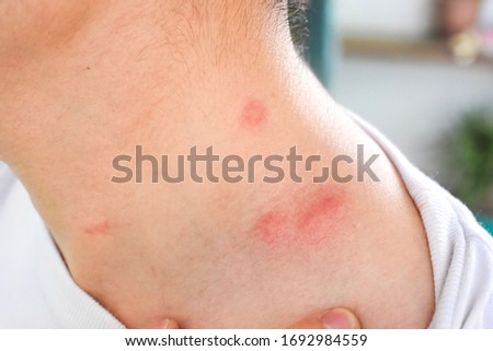 Multiple itchy mosquito or insect bite wheals; allergies in neck and nape area of Southeast Asian, Chinese adult young man with closeup view.