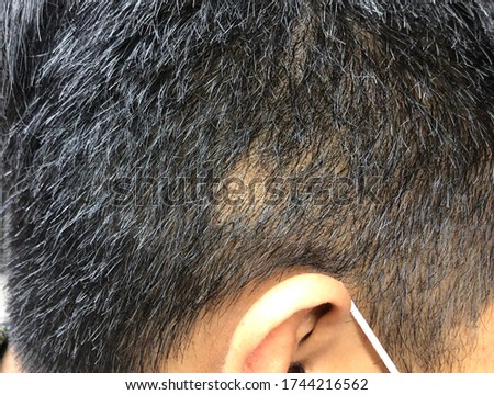 Multiple itchy patch with scale at scalp in case fungal infection.