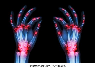 a nyak rheumatoid arthritise térdízület fájdalma a hajlítás és a nyújtás során