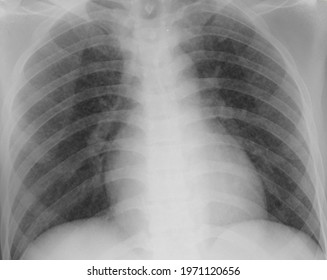 95 Miliary tb Images, Stock Photos & Vectors | Shutterstock