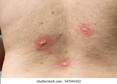  multiple mosquito bites body