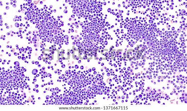 Multiple Myeloma Awareness: Bone marrow aspirate\
cytology of multiple myeloma, a type of bone marrow cancer of\
malignant plasma cells, associated with bone pain, bone  fractures\
and anemia.