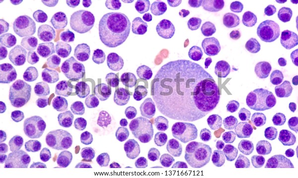 Multiple Myeloma Awareness: Bone marrow aspirate\
cytology of multiple myeloma, a type of bone marrow cancer of\
malignant plasma cells, associated with bone pain, bone  fractures\
and anemia.