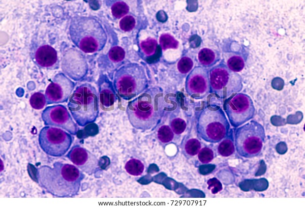 Multiple Myeloma Awareness: Bone marrow aspirate
cytology of multiple myeloma, a type of bone marrow cancer of
malignant plasma cells, associated with bone pain, bone  fractures
and anemia.