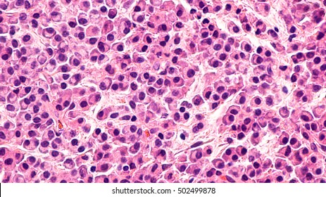 Multiple Myeloma Awareness: Pathology microscopic of bone biopsy of multiple myeloma, a type of bone marrow cancer of malignant plasma cells, associated with bone pain, bone  fractures and anemia.