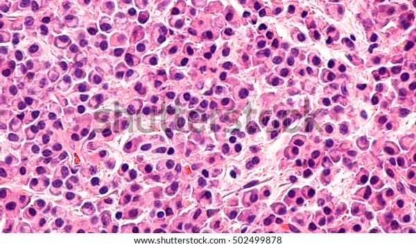 Multiple Myeloma Awareness: Pathology microscopic\
of bone biopsy of multiple myeloma, a type of bone marrow cancer of\
malignant plasma cells, associated with bone pain, bone  fractures\
and anemia.