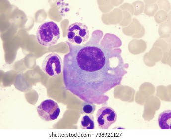 Multiple Myeloma (showing Flame-shaped Plasma Cell)