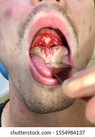 The Multiple Painful Oral Ulcer In Case Acute HIV Infection.