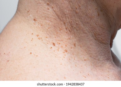 multiple skin papillomatosis)