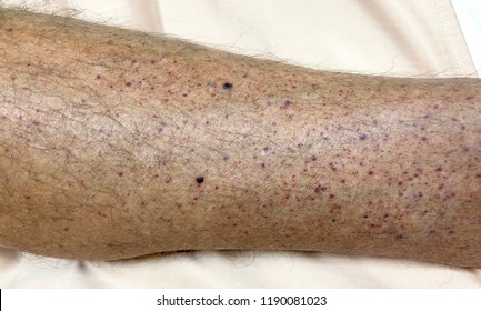 Hemorragia petequia múltiple en la pierna izquierda en caso de púrpura trombocitopénica idiopática (PTI).