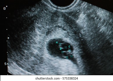 Multiple Pregnancy. Triplets. Ultrasound Diagnostics