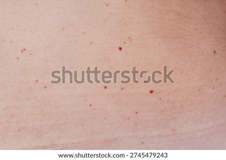 Multiple red dots or moles on the body or senile angiomas