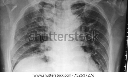 Multiple Rib fractures