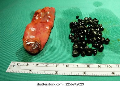 Multiple Small Black Pigmented Gall Bladder Stones With Gall Bladder Specimen.