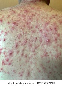 Multiple Well Define Erythematous Maculopapular Rash Whole The Body (this Picture Was Focus On The Back) In Gentle Man Who Had Secondary Syphilis.