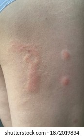 Multiple Well Define Erythematous Wheal And Flare At Right Thigh In Case Acute Idiopathic Urticaria.