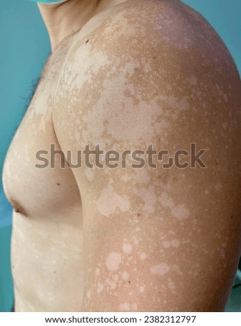 Multiple well-define pruritus white patch at left shoulder in a man who has Tinea Versicolor infection.