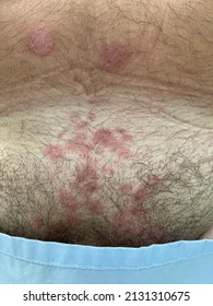 Multiple Well-defined Erythematous Patch With Scale At Suprapubic Region In Case Tinea Cruris.  