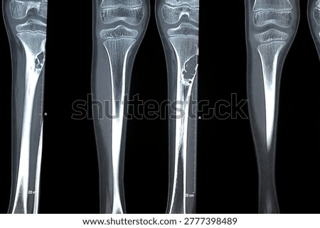 Multislice CT scan show well circumscribed eccentric cortical based lucent lesions, with sclerotic margin at proximal left tibial and fibular shafts with cortical defect at fibular one