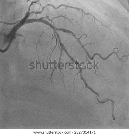 Multi-vessel Coronary Angiogram LAD and LCX