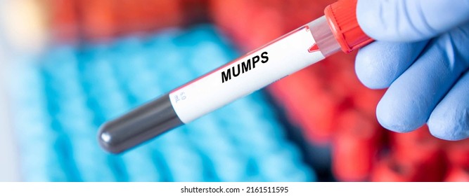 Mumps. Mumps Disease Blood Test In Doctor Hand