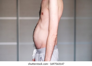 Muscular Dystrophy Of A Man With A Protrusion Of The Abdomen