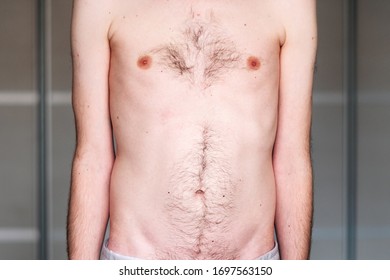 Muscular Dystrophy Of A Man With A Protrusion Of The Abdomen