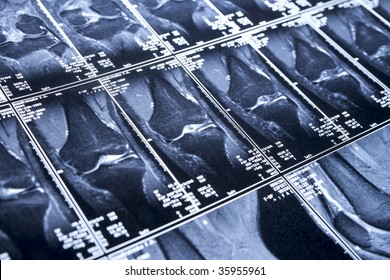 My Knee MRI - Sport Trauma, Side View