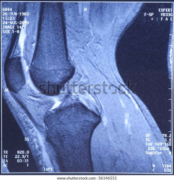 My Knee Mri Sport Trauma Damage Stock Photo (Edit Now) 36146551