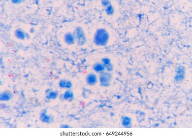 Mycobacterium Tuberculosis Acid Fast Stain Stock Photo 649244956 ...