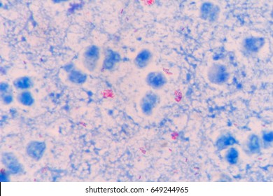 Mycobacterium Tuberculosis Acid Fast Stain Stock Photo 649244965 ...