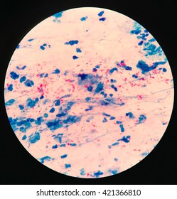 Mycobacterium Tuberculosis In Sputum