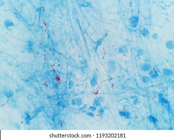 Mycobacterium Tuberculosis In Sputum. Acid Fast (Ziehl Neelsen) Staining At 1000x Magnification