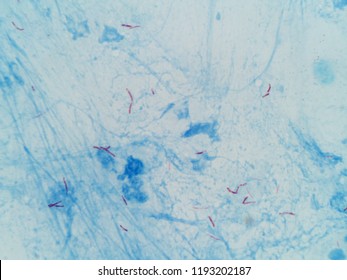 Mycobacterium Tuberculosis In Sputum. Acid Fast (Ziehl Neelsen) Staining At 1000x Magnification