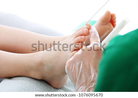 Mycosis of the feet and nails. The dermatologist takes a swab from the patient's nail shaft.
