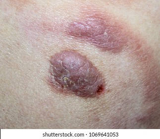 Mycosis Fungoides (cutaneous T-cell Lymphoma).