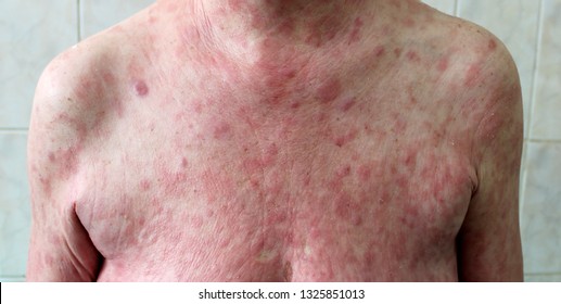 HPV fertőzés - Humán papillomavírus mycosis